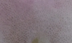 为什么我会得白癜风？白癜风的病因有哪些？