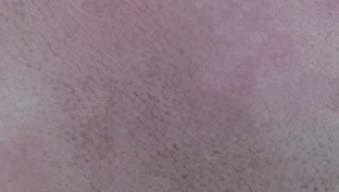 白癜风难治愈！了解5个病因，做好预防是关键