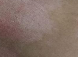 白癜风产生的原因都有哪些