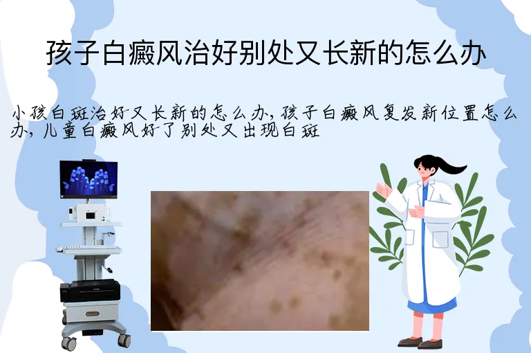孩子白癜风治好别处又长新的怎么办