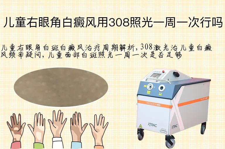 儿童右眼角白癜风用308照光一周一次行吗