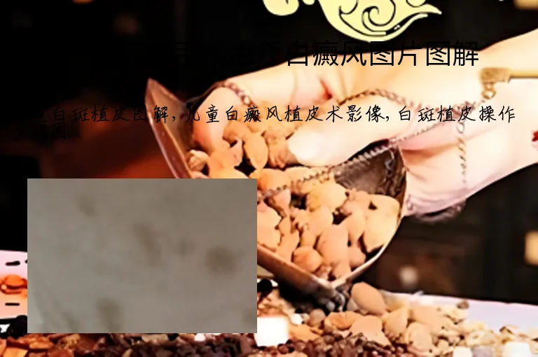 儿童植皮手术治疗白癜风图片图解