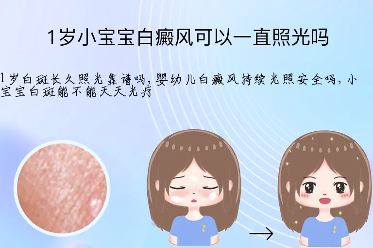 1岁小宝宝白癜风可以一直照光吗