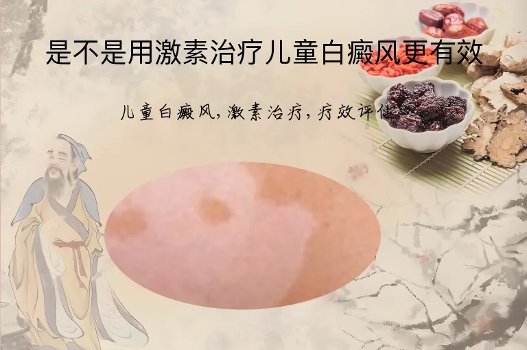 是不是用激素治疗儿童白癜风更有效