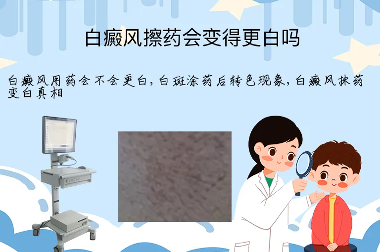 白癜风擦药会变得更白吗
