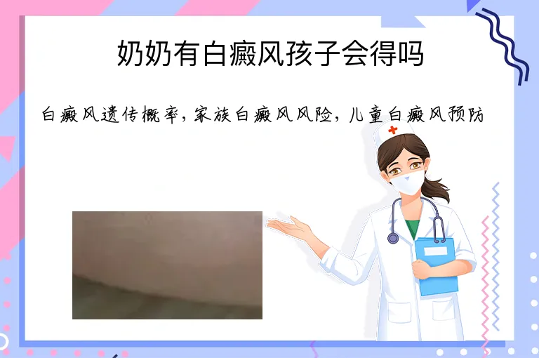 奶奶有白癜风孩子会得吗