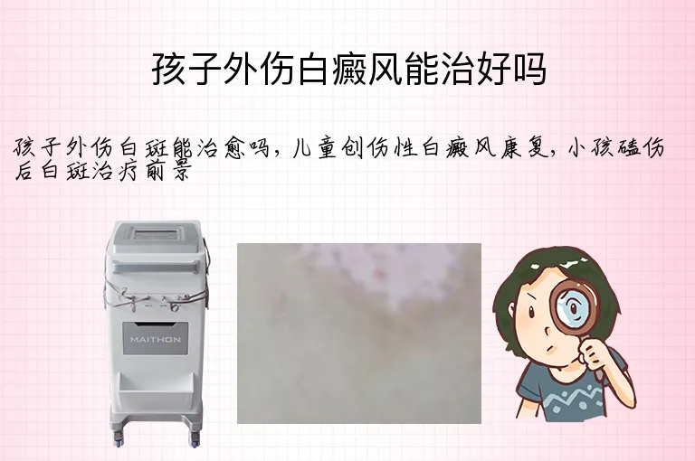 孩子外伤白癜风能治好吗