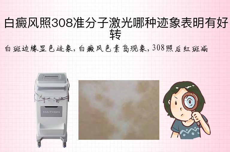 白癜风照308准分子激光哪种迹象表明有好转