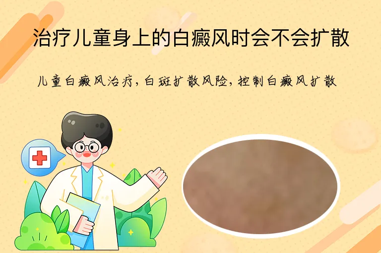 治疗儿童身上的白癜风时会不会扩散