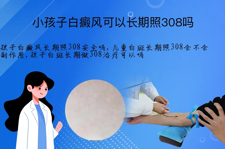 小孩子白癜风可以长期照308吗