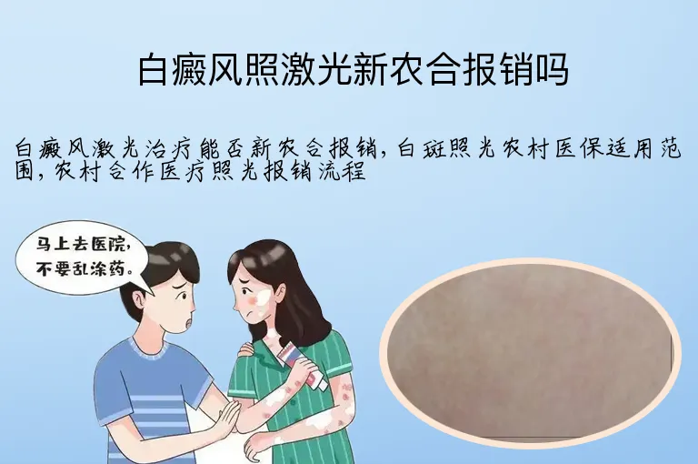 白癜风照激光新农合报销吗