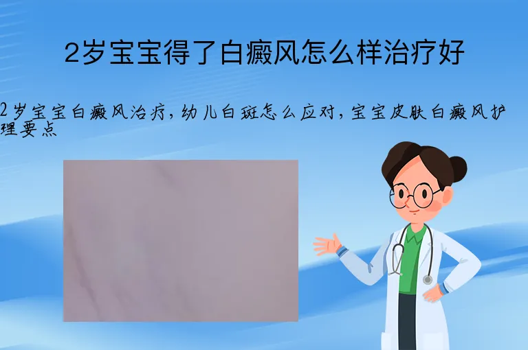 2岁宝宝得了白癜风怎么样治疗好