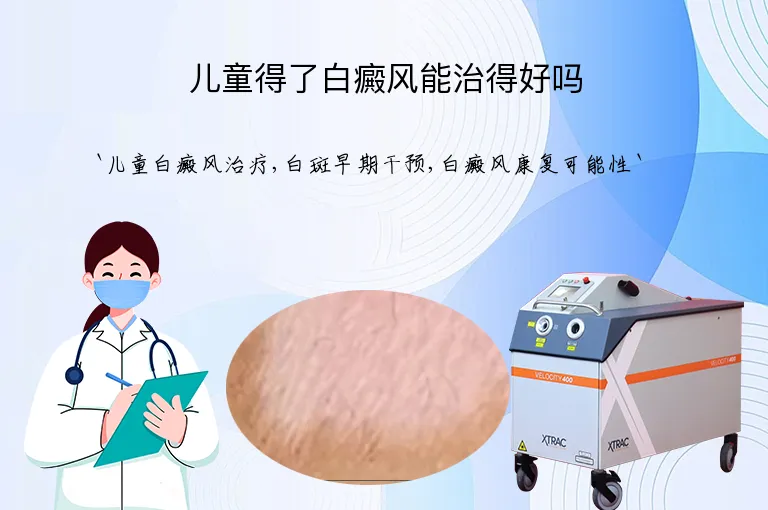 儿童得了白癜风能治得好吗