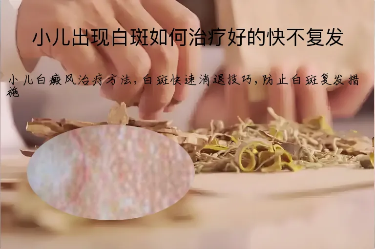 小儿出现白斑如何治疗好的快不复发