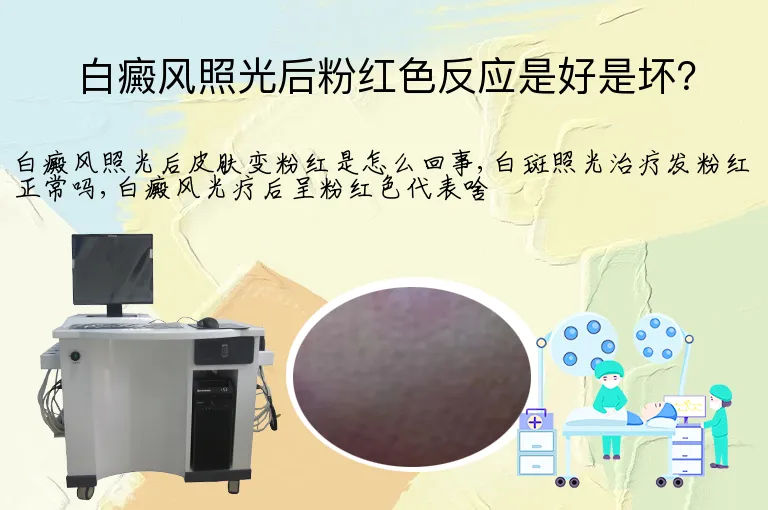 白癜风照光后粉红色反应是好是坏?