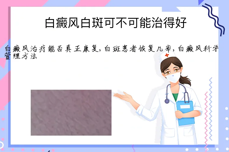 白癜风白斑可不可能治得好