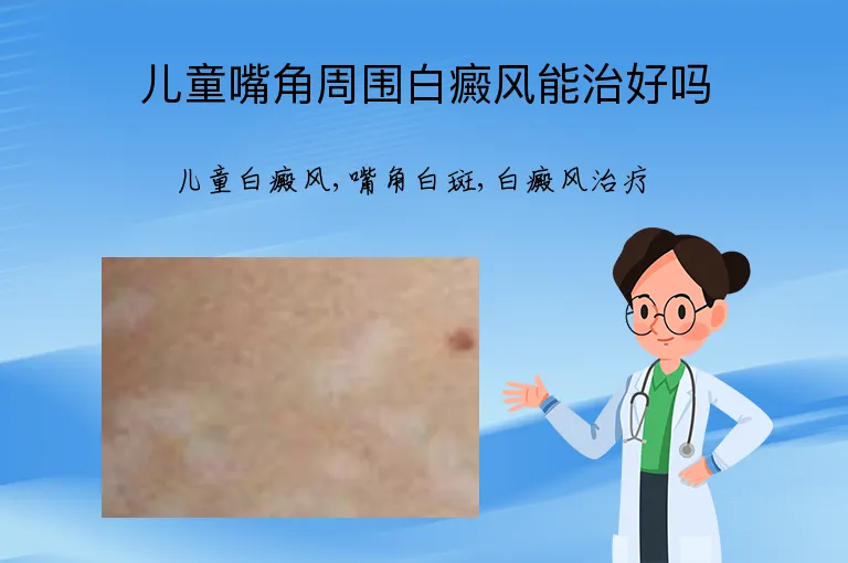 儿童嘴角周围白癜风能治好吗