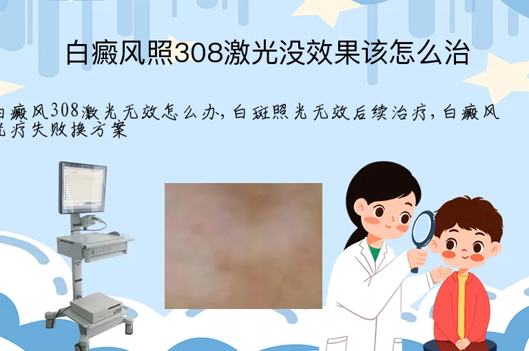 白癜风照308激光没效果该怎么治