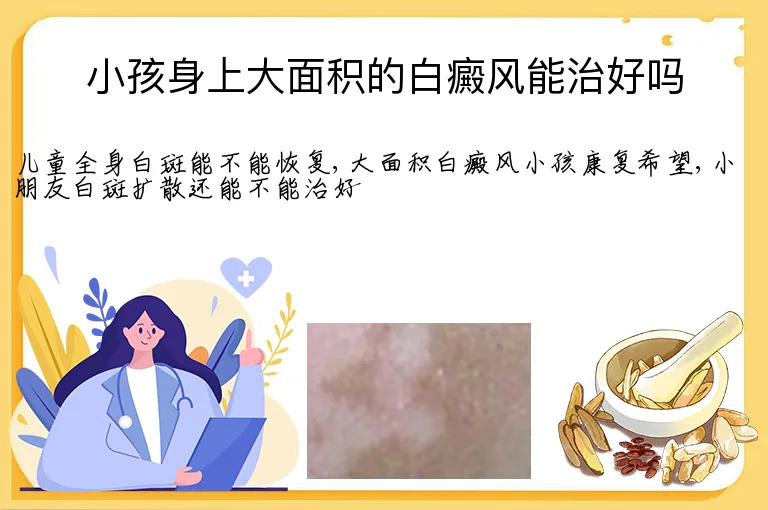 小孩身上大面积的白癜风能治好吗