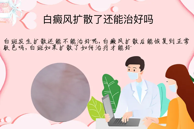 白癜风扩散了还能治好吗