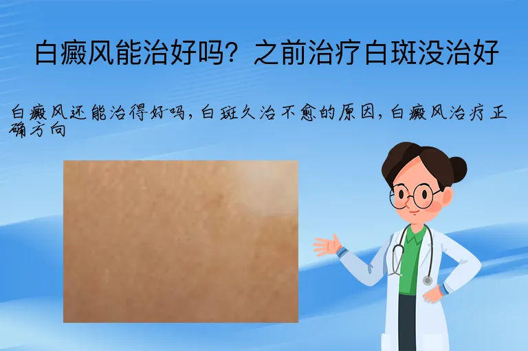 白癜风能治好吗？之前治疗白斑没治好