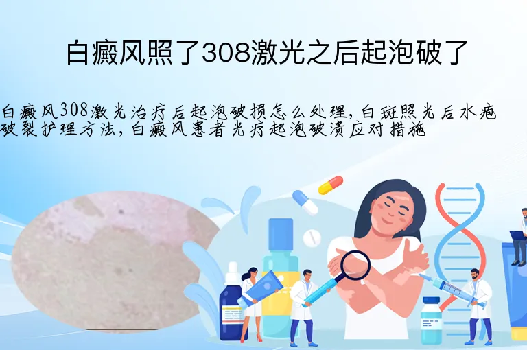 白癜风照了308激光之后起泡破了