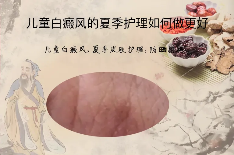 儿童白癜风的夏季护理如何做更好