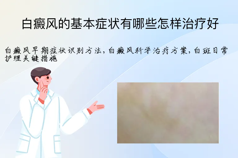 白癜风的基本症状有哪些怎样治疗好