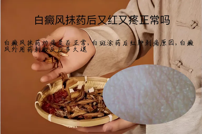 白癜风抹药后又红又疼正常吗