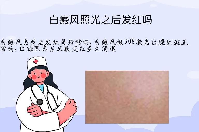 白癜风照光之后发红吗