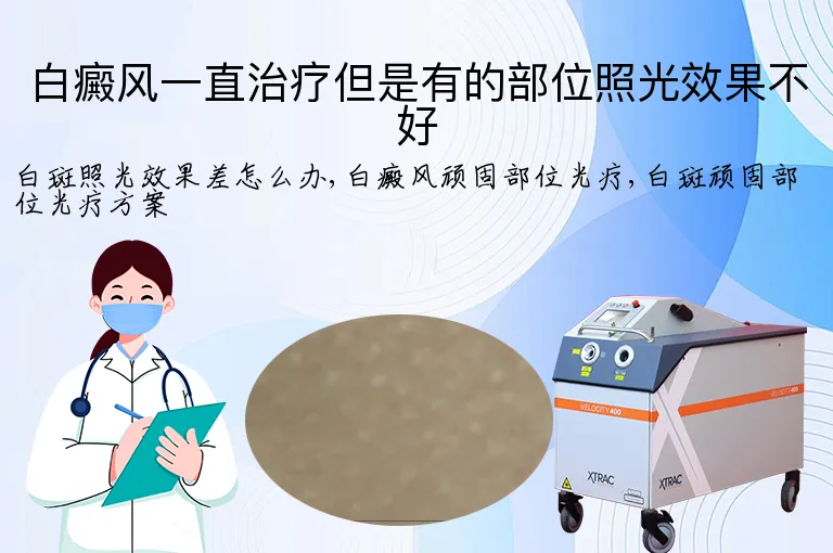 白癜风一直治疗但是有的部位照光效果不好