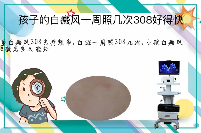 孩子的白癜风一周照几次308好得快
