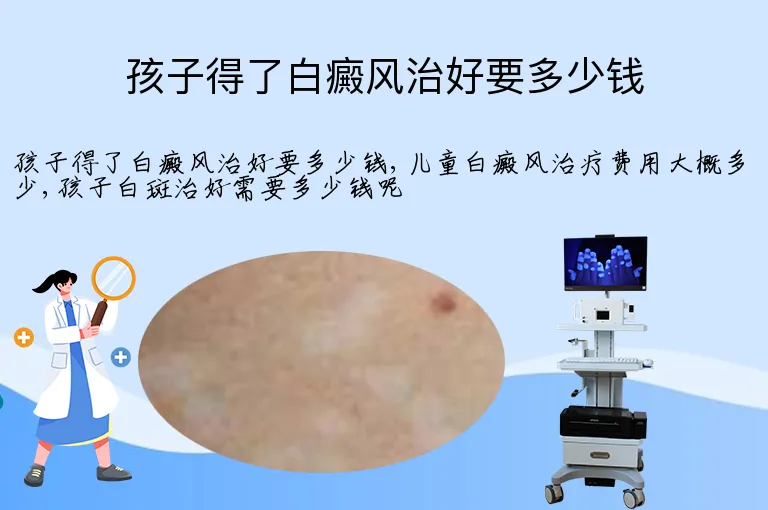 孩子得了白癜风治好要多少钱