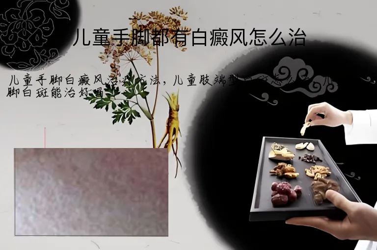 儿童手脚都有白癜风怎么治