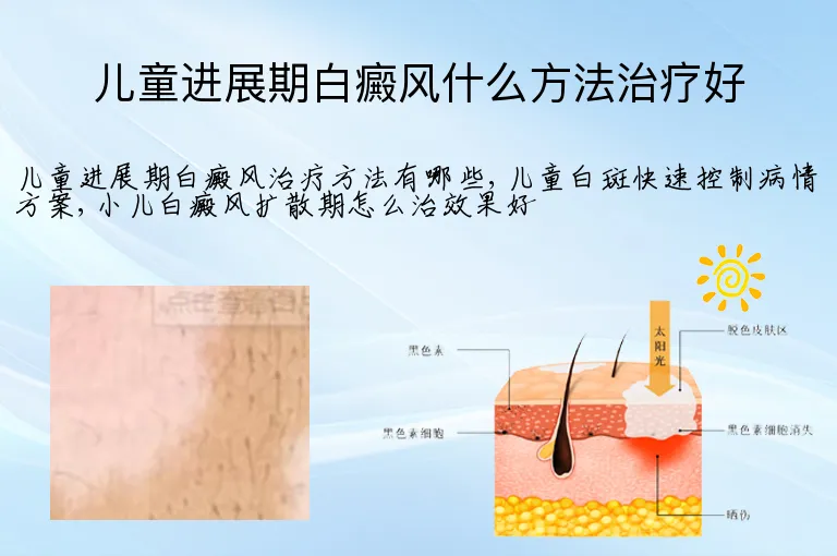 儿童进展期白癜风什么方法治疗好