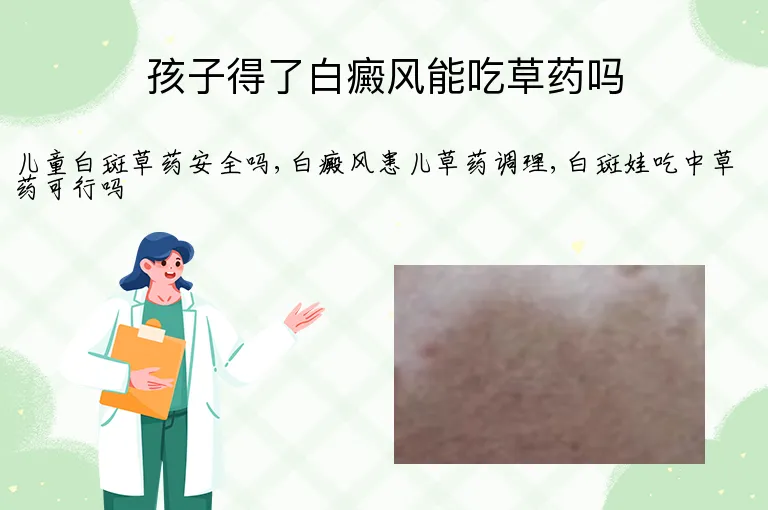 孩子得了白癜风能吃草药吗