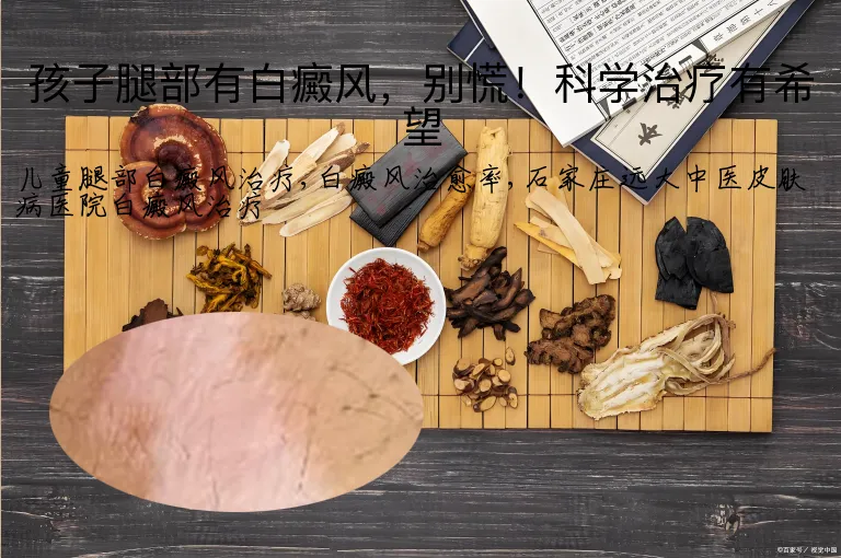 孩子腿部有白癜风，别慌！科学治疗有希望
