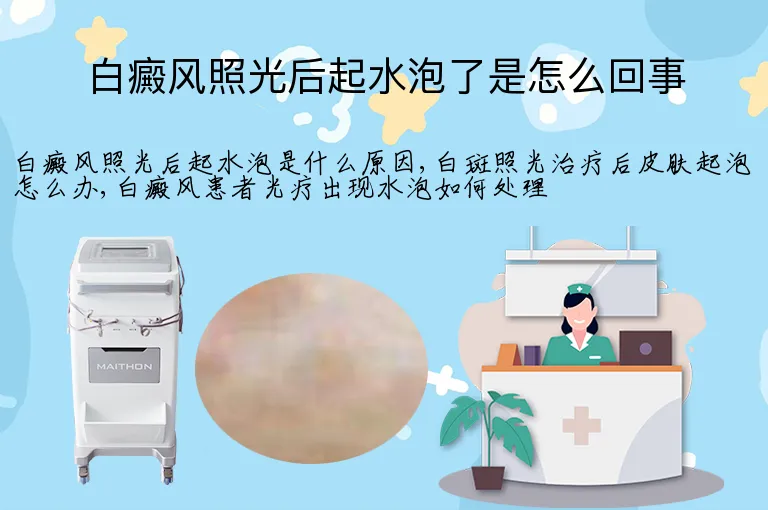白癜风照光后起水泡了是怎么回事