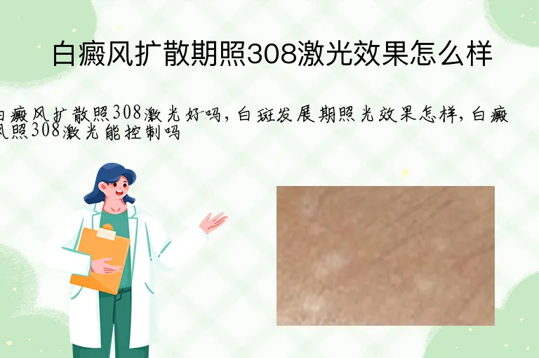 白癜风扩散期照308激光效果怎么样