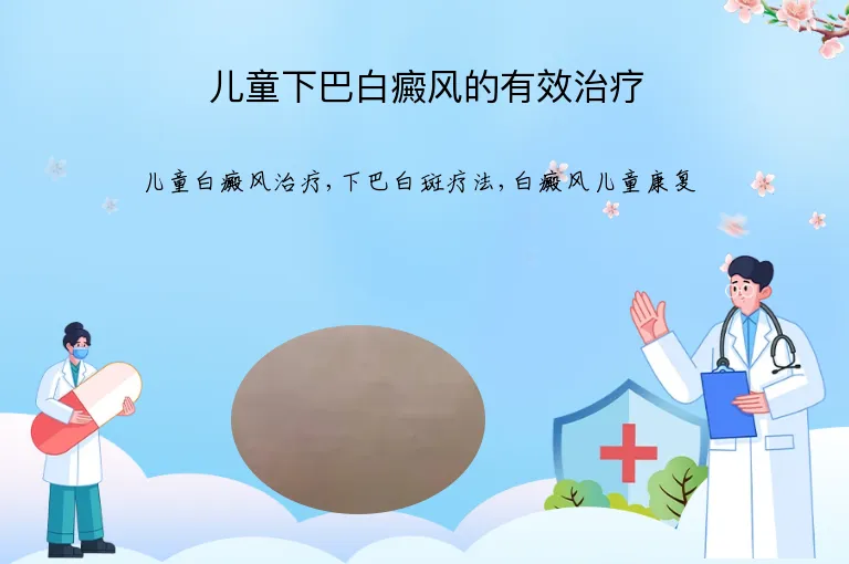 儿童下巴白癜风的有效治疗