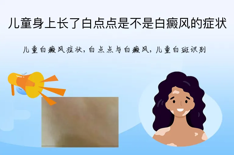 儿童身上长了白点点是不是白癜风的症状