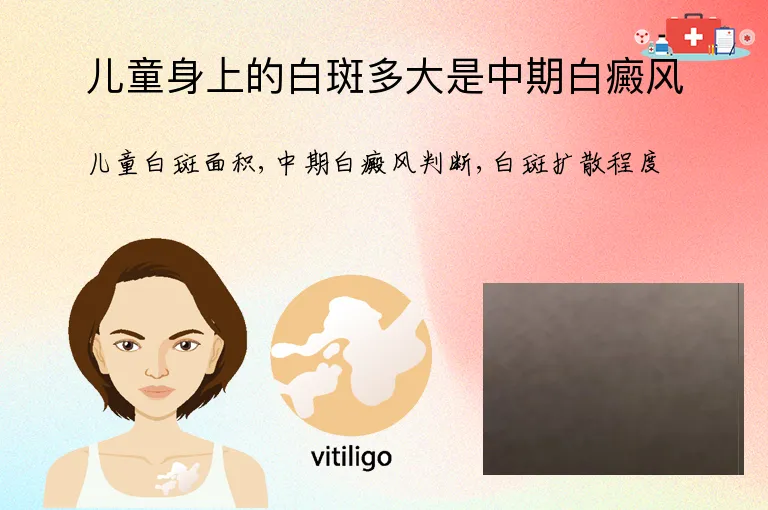 儿童身上的白斑多大是中期白癜风