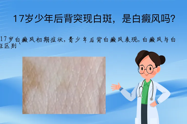 17岁少年后背突现白斑，是白癜风吗？