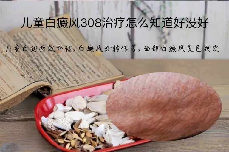 儿童白癜风308治疗怎么知道好没好