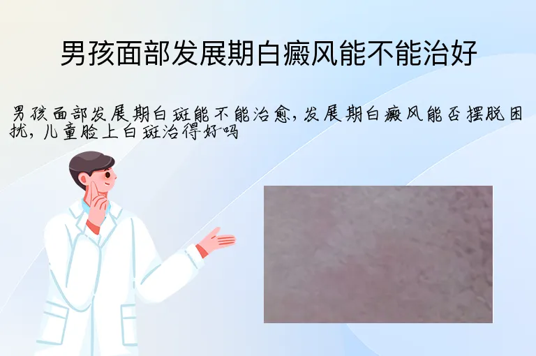 男孩面部发展期白癜风能不能治好