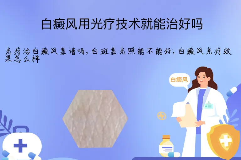 白癜风用光疗技术就能治好吗