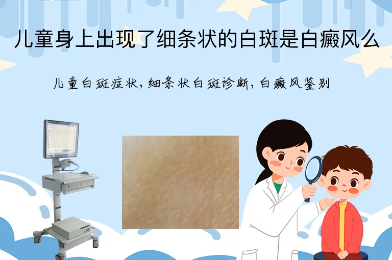 儿童身上出现了细条状的白斑是白癜风么
