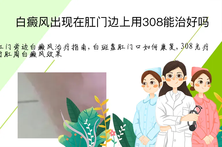白癜风出现在肛门边上用308能治好吗