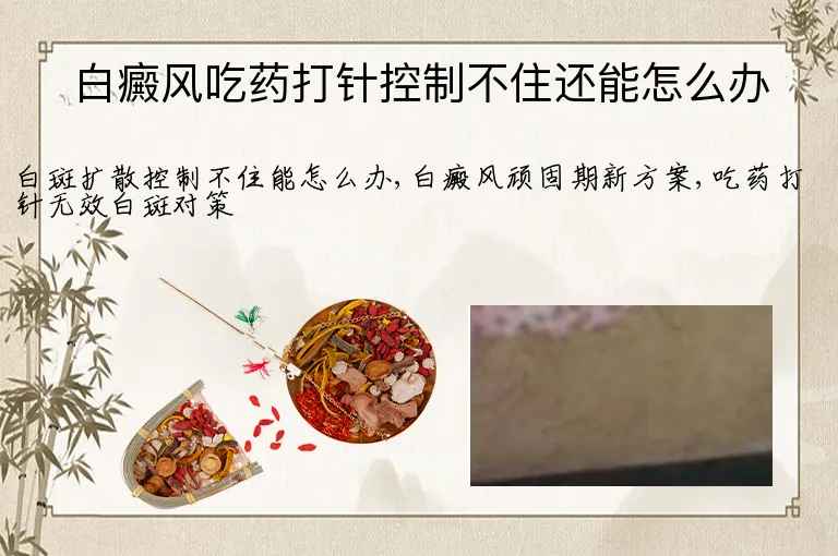 白癜风吃药打针控制不住还能怎么办