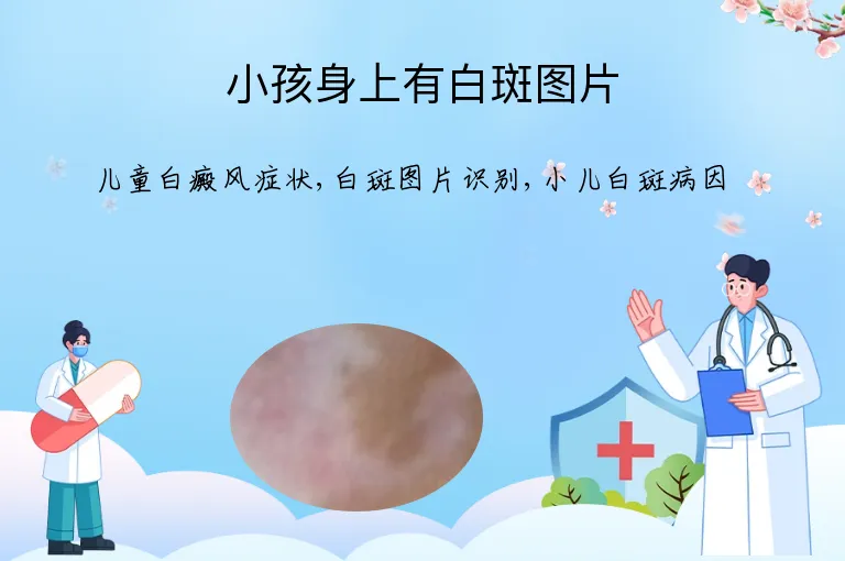 小孩身上有白斑图片